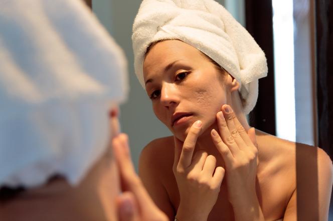 A woman looks at acne scars in the mirror