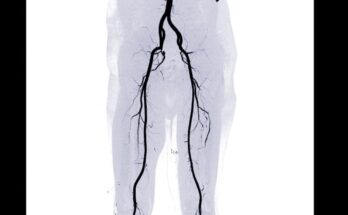 Where is the femoral artery located?