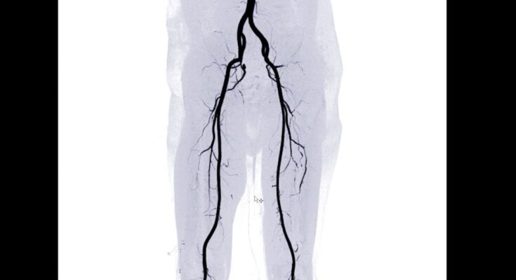 Where is the femoral artery located?