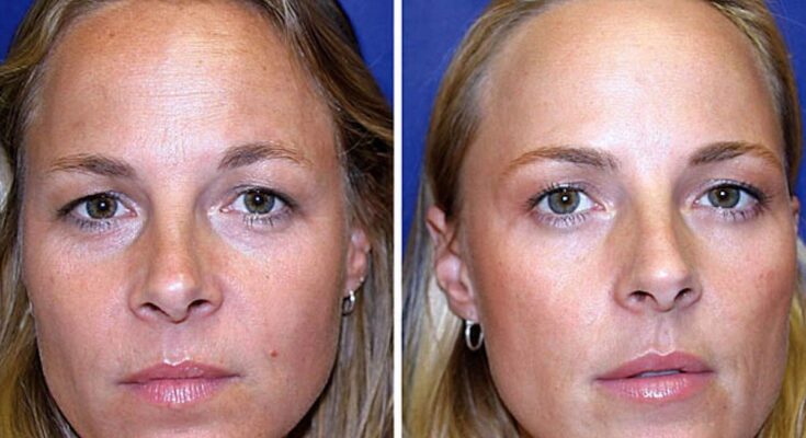 A study on twins reveals the true effects of botox on the face