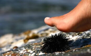 After stepping on a sea urchin, he had 3 toes amputated.  Doctors explain this complication