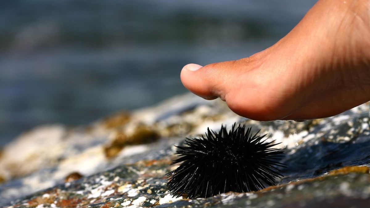 After stepping on a sea urchin, he had 3 toes amputated.  Doctors explain this complication