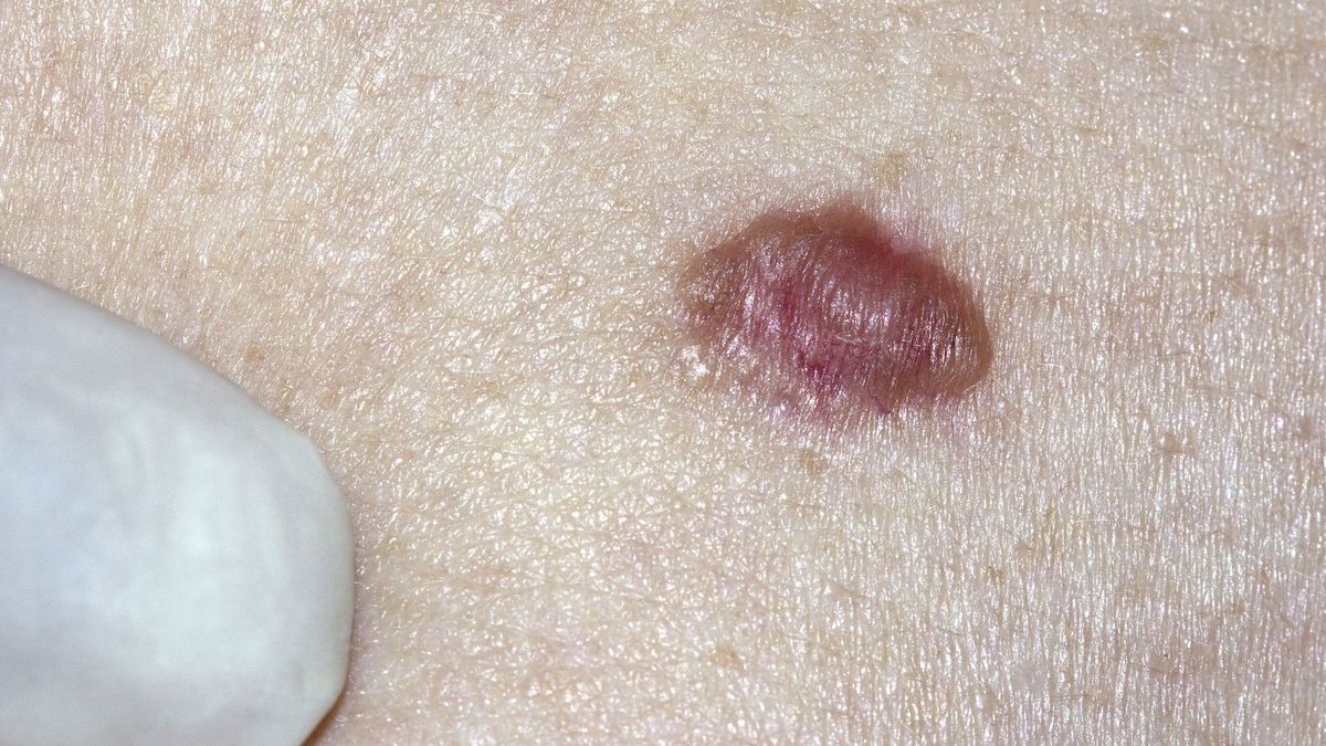 Basal cell carcinoma: symptoms, treatment, prevention, is it serious?