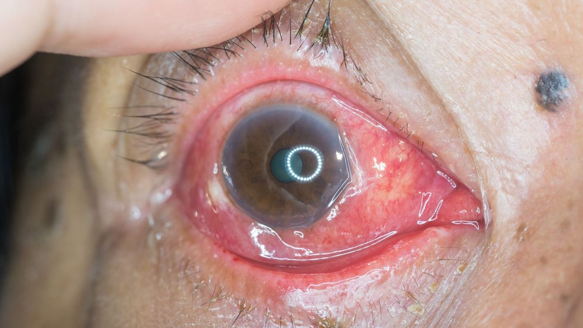 Chemosis: symptoms, causes, how to treat it?