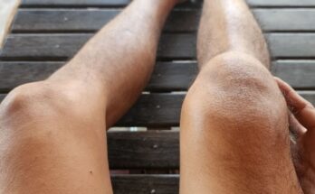 Dislocation of the patella: what to do?
