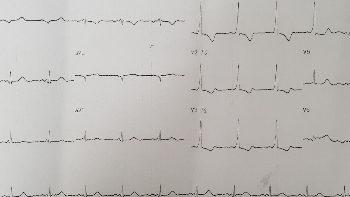 Le syndrome de Wolff Parkinson White or WPW