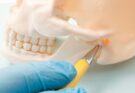 Maxillary fracture: what treatment?