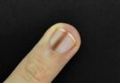 Nail disease: when to suspect cancer?