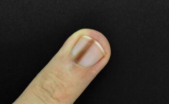 Nail disease: when to suspect cancer?