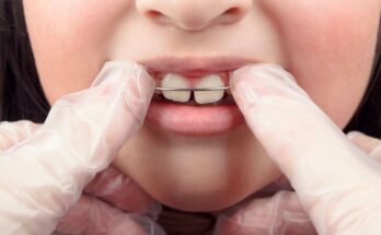 Orthodontics: more than one in two French people still do not know the ideal age for a first consultation