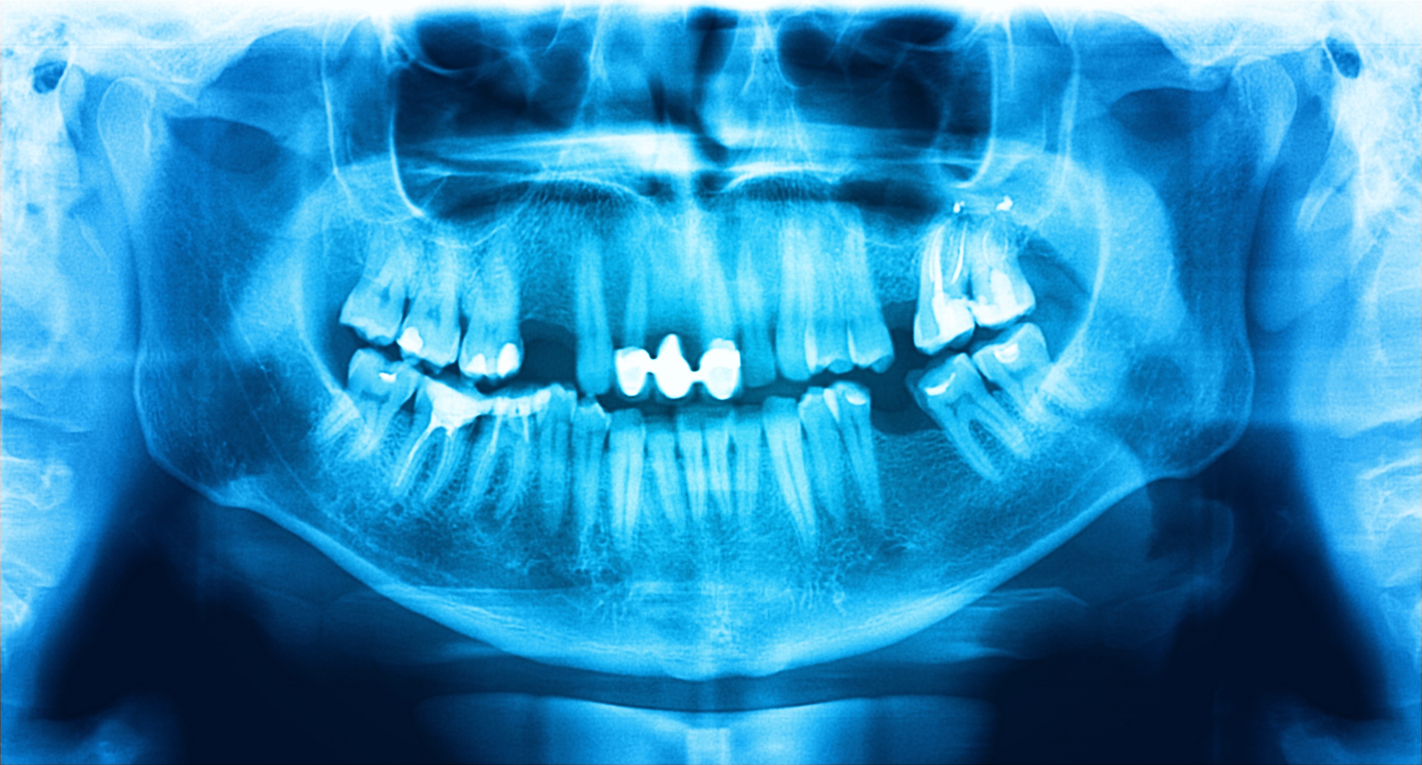 dental panoramic x-ray