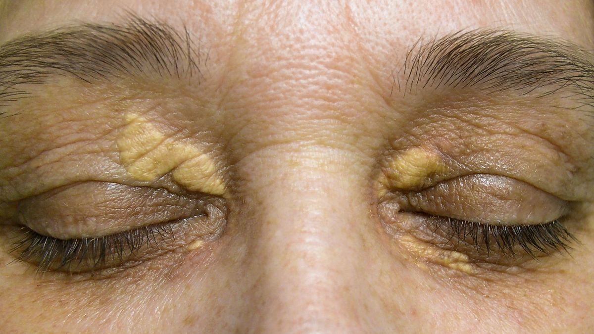 Xanthelasma: causes, symptoms, how to treat it?