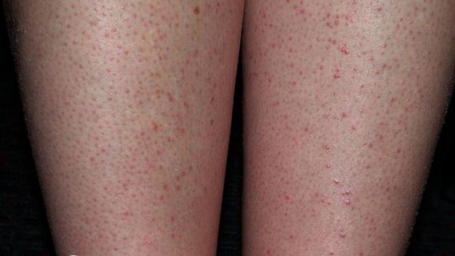 Strawberry legs (red spots after depilation)